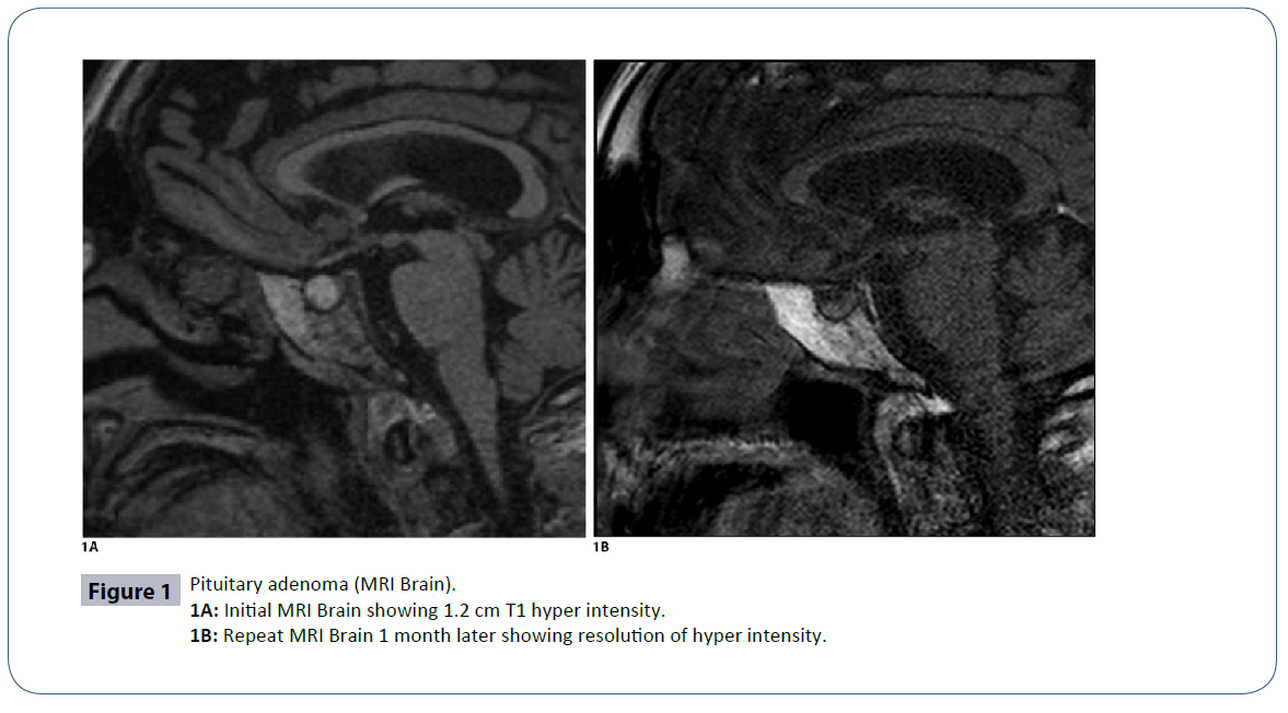 headache-Pituitary-adenoma