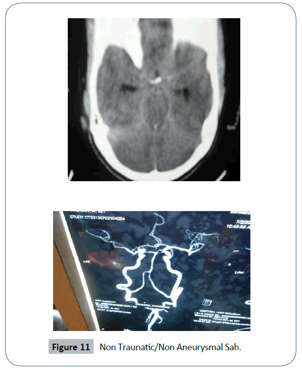 headache-pain-management-Aneurysmal-Sah