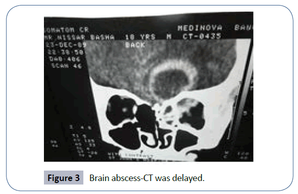 headache-pain-management-Brain-abscess