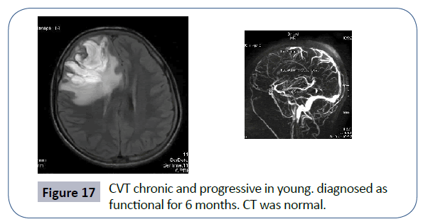 headache-pain-management-CVT-chronic