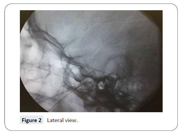 headache-pain-management-Lateral-view