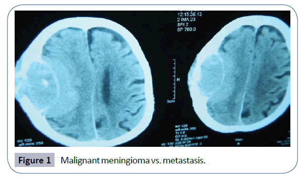 headache-pain-management-Malignant-meningioma