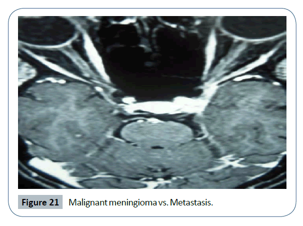 headache-pain-management-Malignant-meningioma