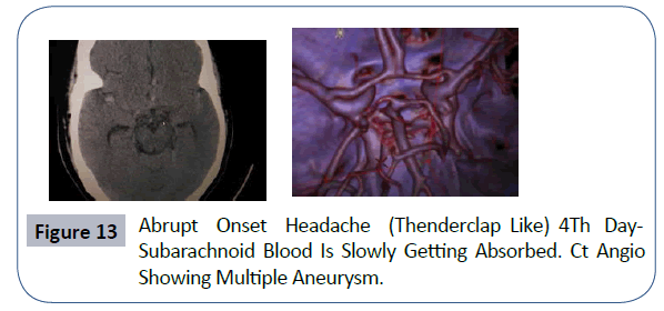 headache-pain-management-Multiple-Aneurysm