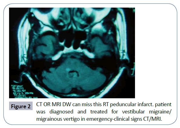 headache-pain-management-RT-peduncular