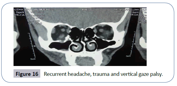 headache-pain-management-Recurrent-headache