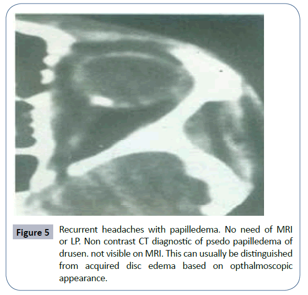 headache-pain-management-Recurrent-headaches