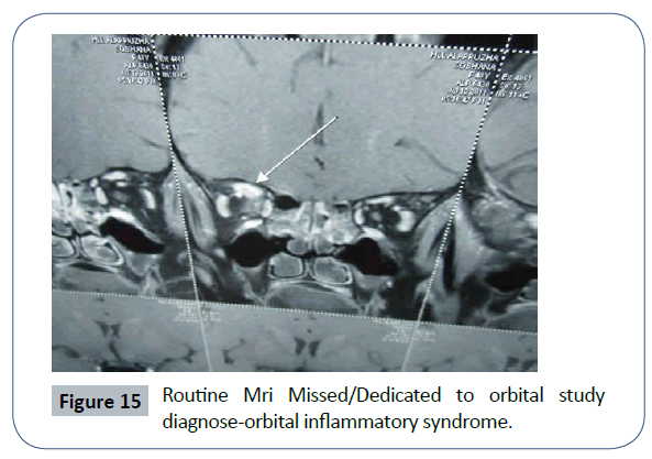 headache-pain-management-Routine-Mri