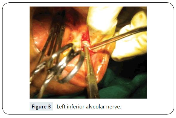 headache-pain-management-alveolar-nerve