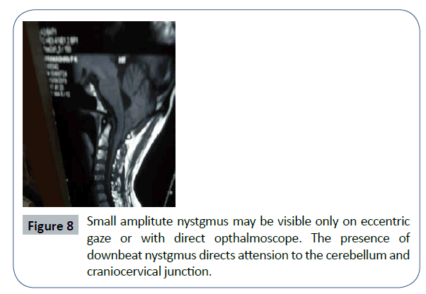 headache-pain-management-amplitute-nystgmus