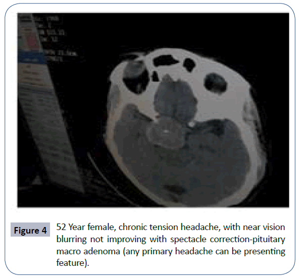 headache-pain-management-chronic-tension