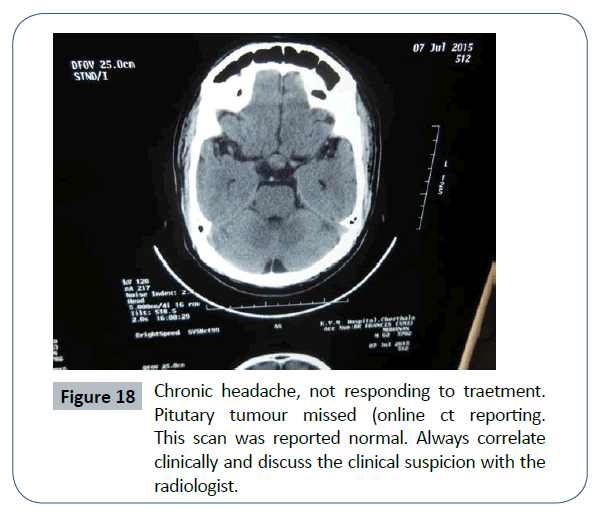 headache-pain-management-clinical-suspicion