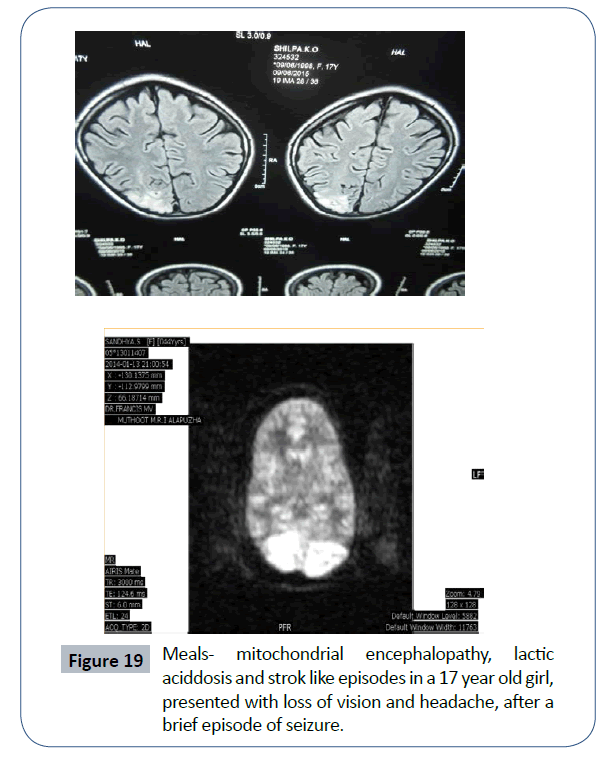 headache-pain-management-episode-seizure