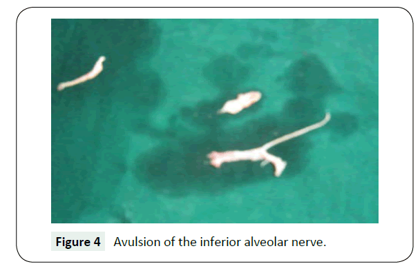 headache-pain-management-inferior-alveolar