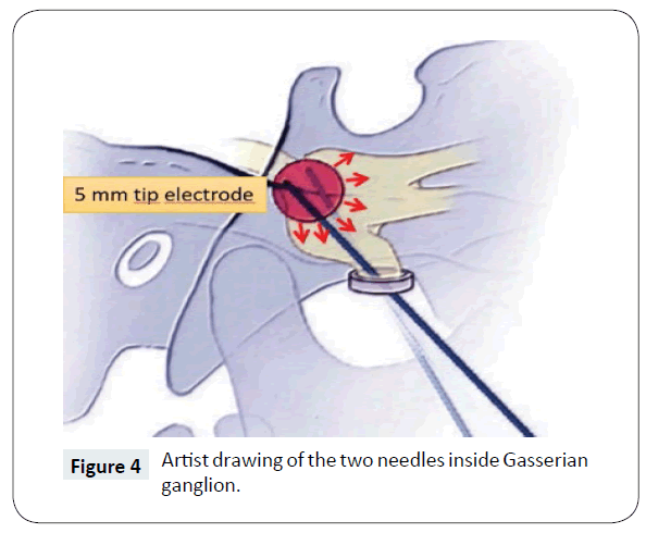 headache-pain-management-inside-Gasserian