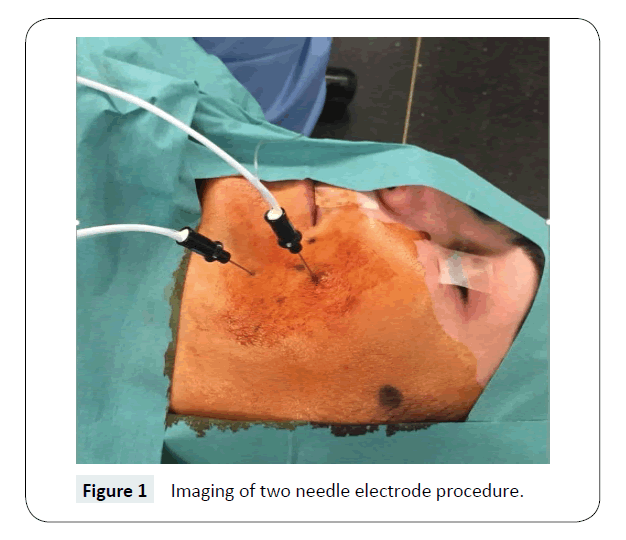 headache-pain-management-needle-electrode