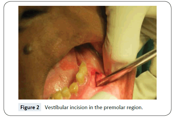 headache-pain-management-premolar-region