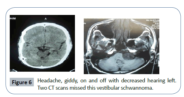 headache-pain-management-vestibular-schwannoma